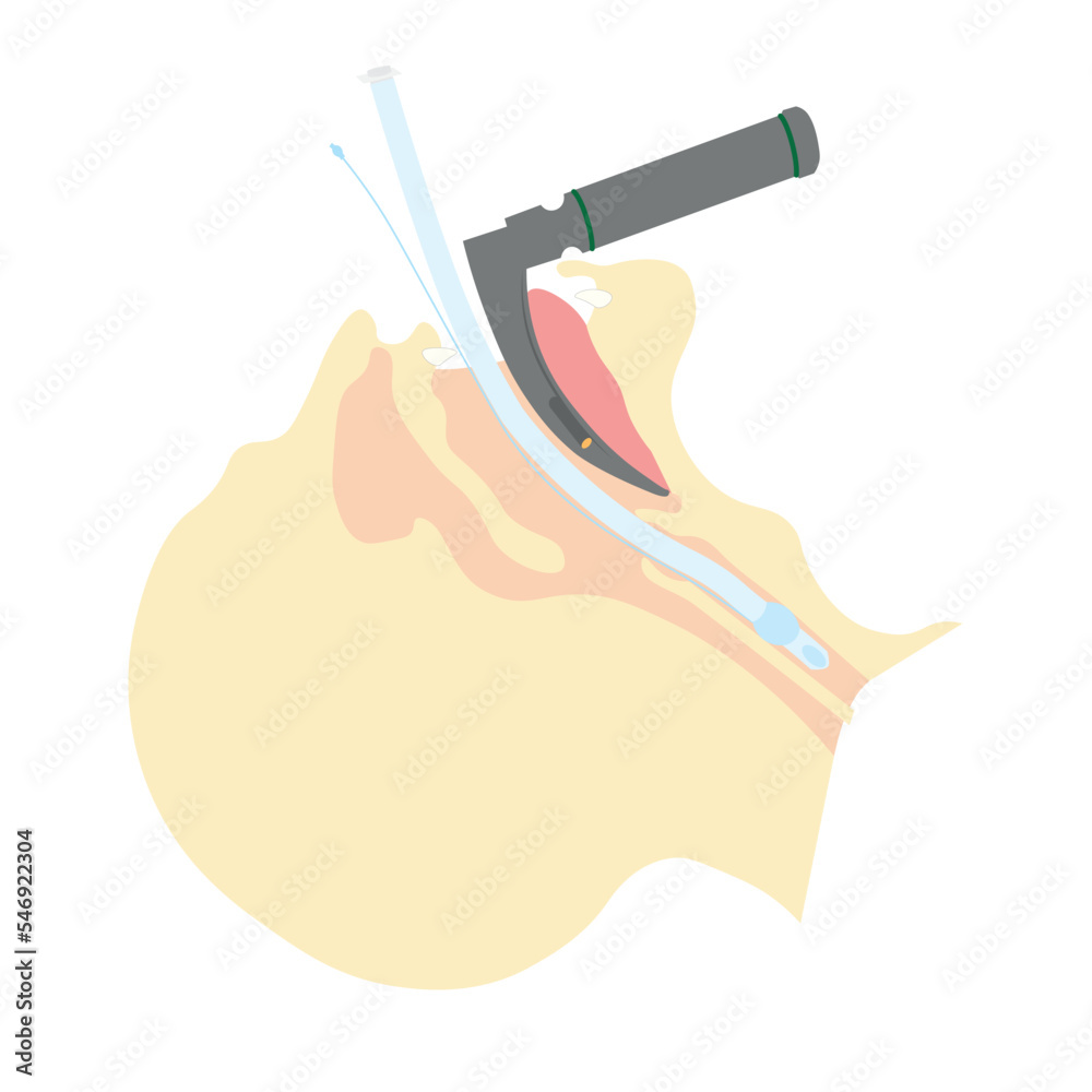 Endotracheal intubation illustration. Laryngoscopy with intubation