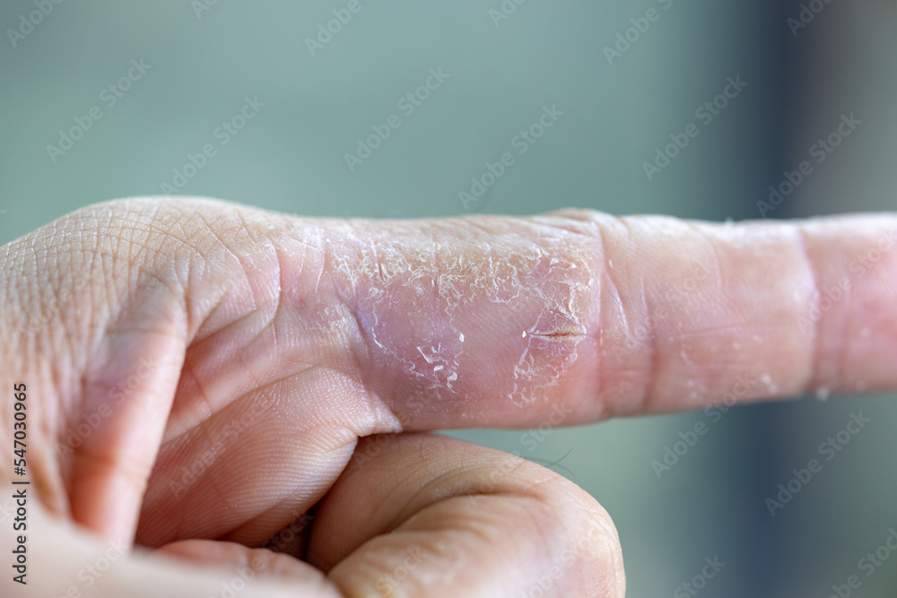 Skin Diseases On Fingers