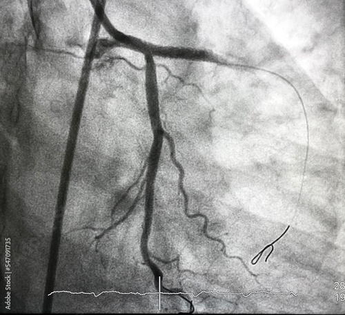Obraz na plátne coronary angiogram shown massive thrombus that occluded left anterior descending artery (LAD) in patient with ST elevation myocardial infarction (STEMI)
