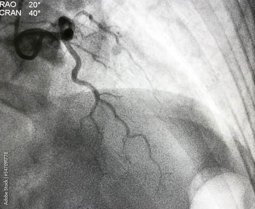 Canvas Print coronary angiogram shown massive thrombus that occluded left anterior descending artery (LAD) in patient with ST elevation myocardial infarction (STEMI)