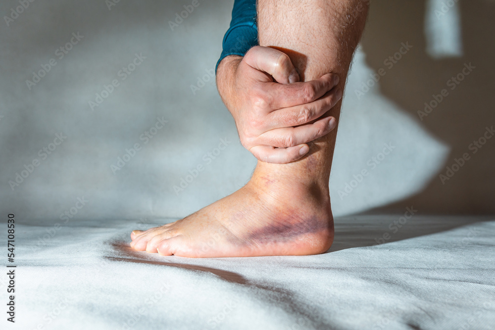 Sprained and swollen ankle.Man hold his sprained ankle at home. Ankle ...