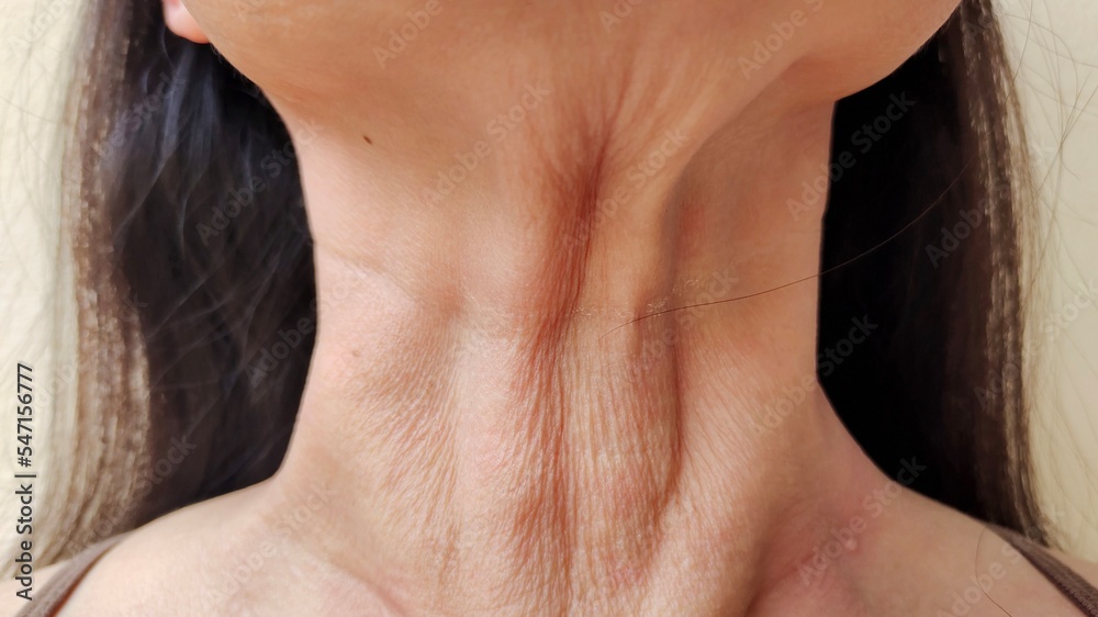 portrait showing the flabbiness adipose sagging skin, wattle and flabby skin under the chin, problem wrinkles and lines under the neck of the woman, health care and beauty concept. portrait showing the flabbiness adipose sagging skin, wattle and flabby skin under the chin, problem wrinkles and lines under the neck of the woman, health care and beauty concept.
