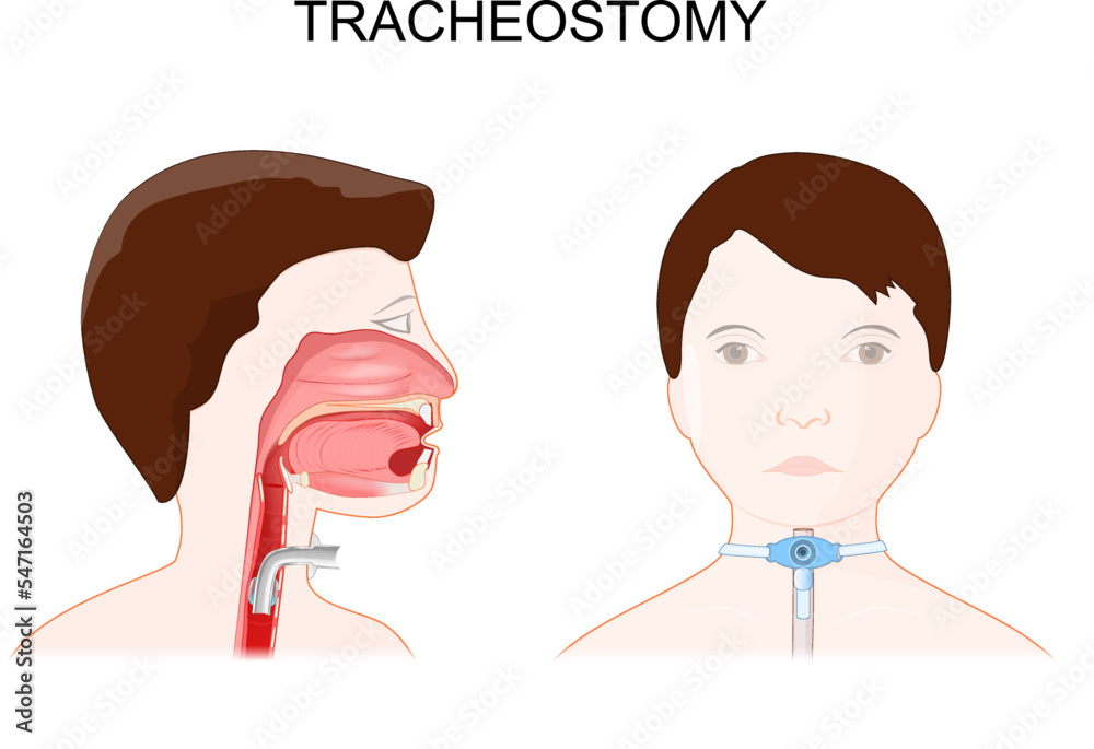 Tracheotomy. side view of the neck and placement of a tracheostomy tube