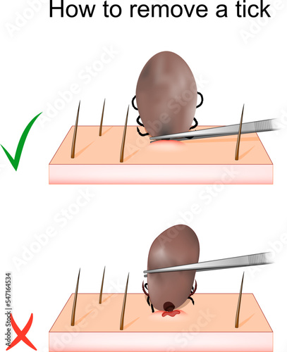 How to remove a tick. mite Removal.