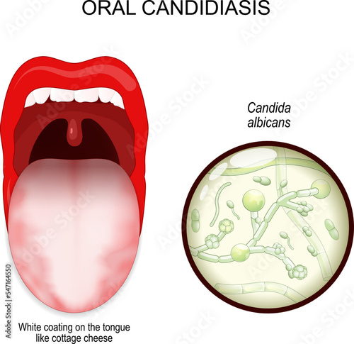 oral candidiasis. oral thrush yeast infection. photo