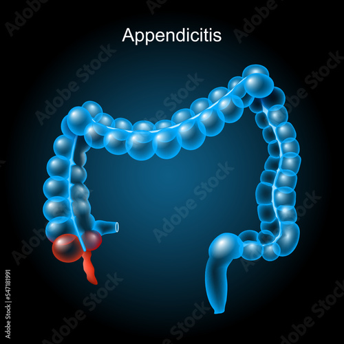 Appendicitis. large intestine on dark background.