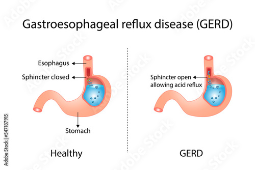  Gastroesophageal Reflux Disease (GERD), Heartburn. Heartburn is caused by stomach acid escaping back into the esophagus because the esophageal sphincter does not close tightly enough. Vector design. photo