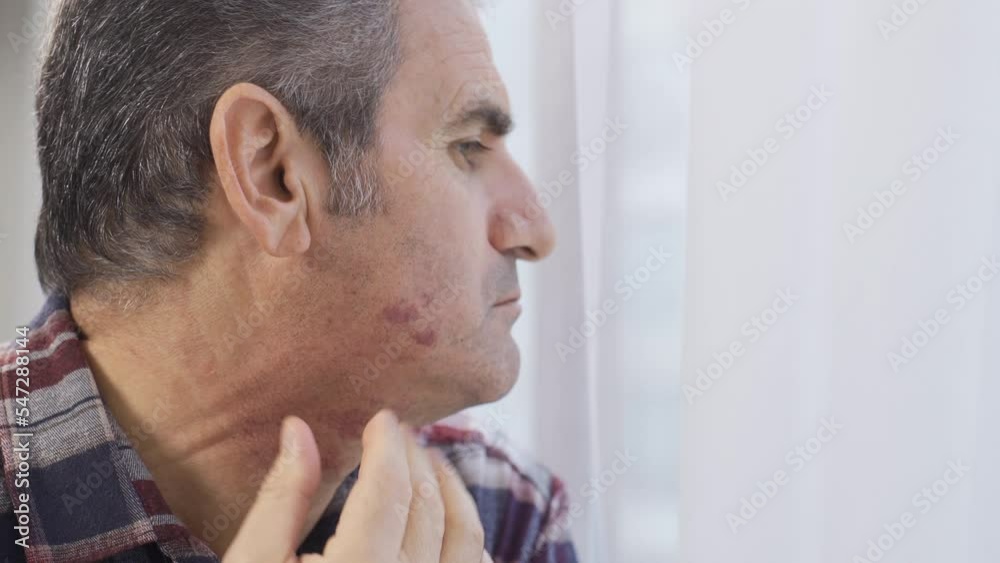 The man with the rose stain on his face. Facial irritation.
The man looking in the mirror at the rose stains on his face.
The man with the rose stain on his face. Facial irritation.
The man looking in the mirror at the rose stains on his face.