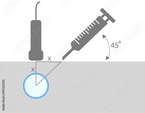 Animation of Method of Ultrasound Guided Central Venous Catheter Insertion