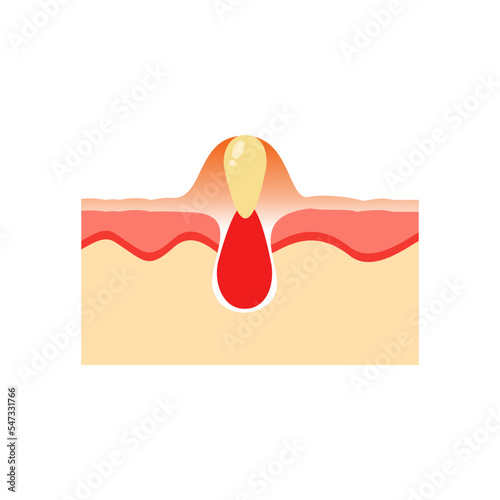 vector illustration of acne skin anatomy, whitehead. epidermis and desmis of the skin. illustration for skin medical science and health.