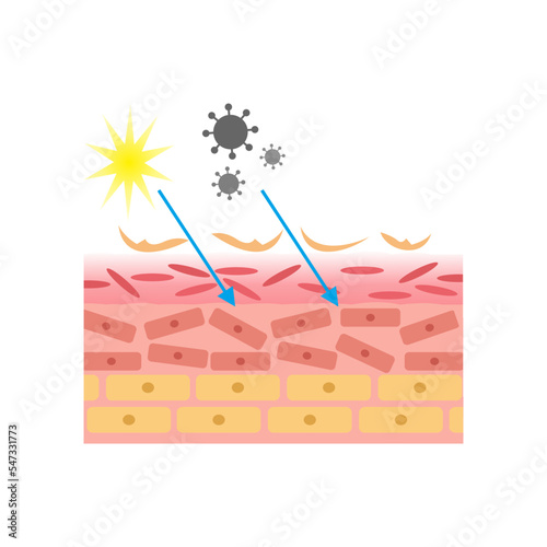 vector illustration of human skin structure anatomy. damaged and exposed by bacteria, dirt and UV rays. epidermis and desmis. illustration for science and medical health.