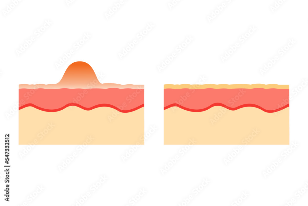 vector illustration of an anatomy comparison of healthy and acneprone skin. epidermis and