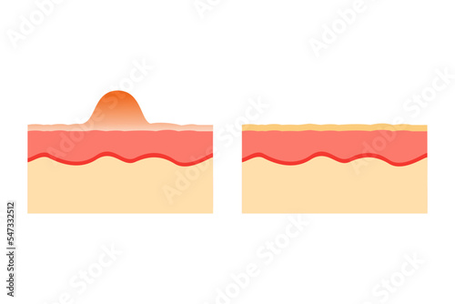 vector illustration of an anatomy comparison of healthy and acne-prone skin. epidermis and desmis of the skin. illustration for skin medical science and health.