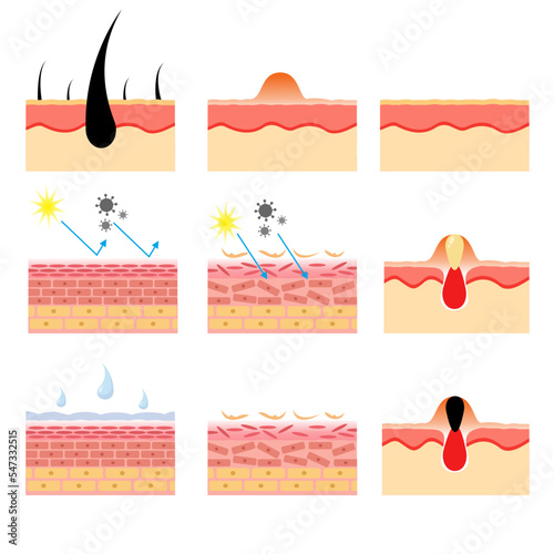 vector illustration of human skin structure anatomy. various skin conditions. epidermis and desmis. illustration for science and medical health. photo