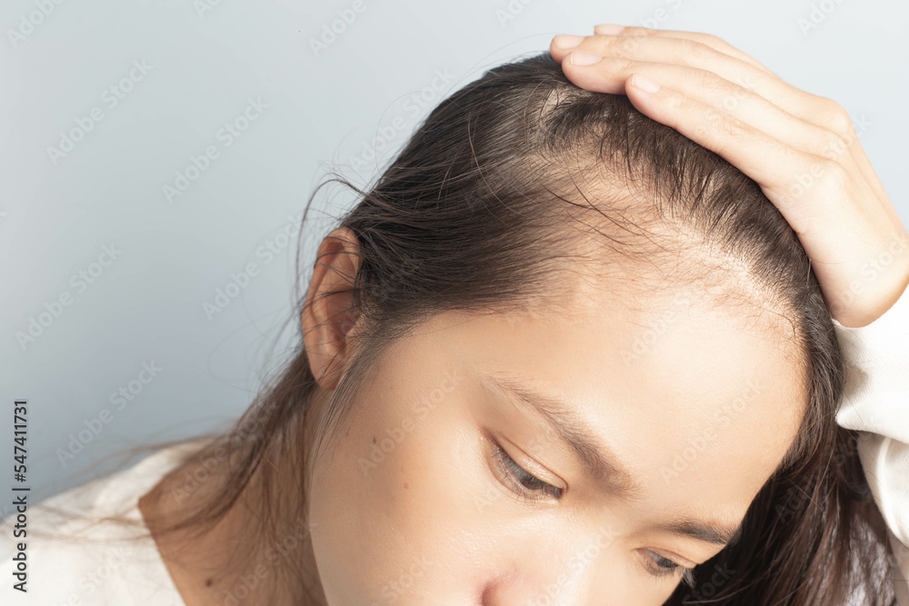 Fototapeta premium Young women stressed and having hair loss, thinning hair.