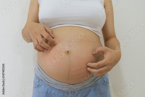 Pregnant woman scratching belly because itchy skin which causes striped, Pregnancy medicine concept. © Suksan