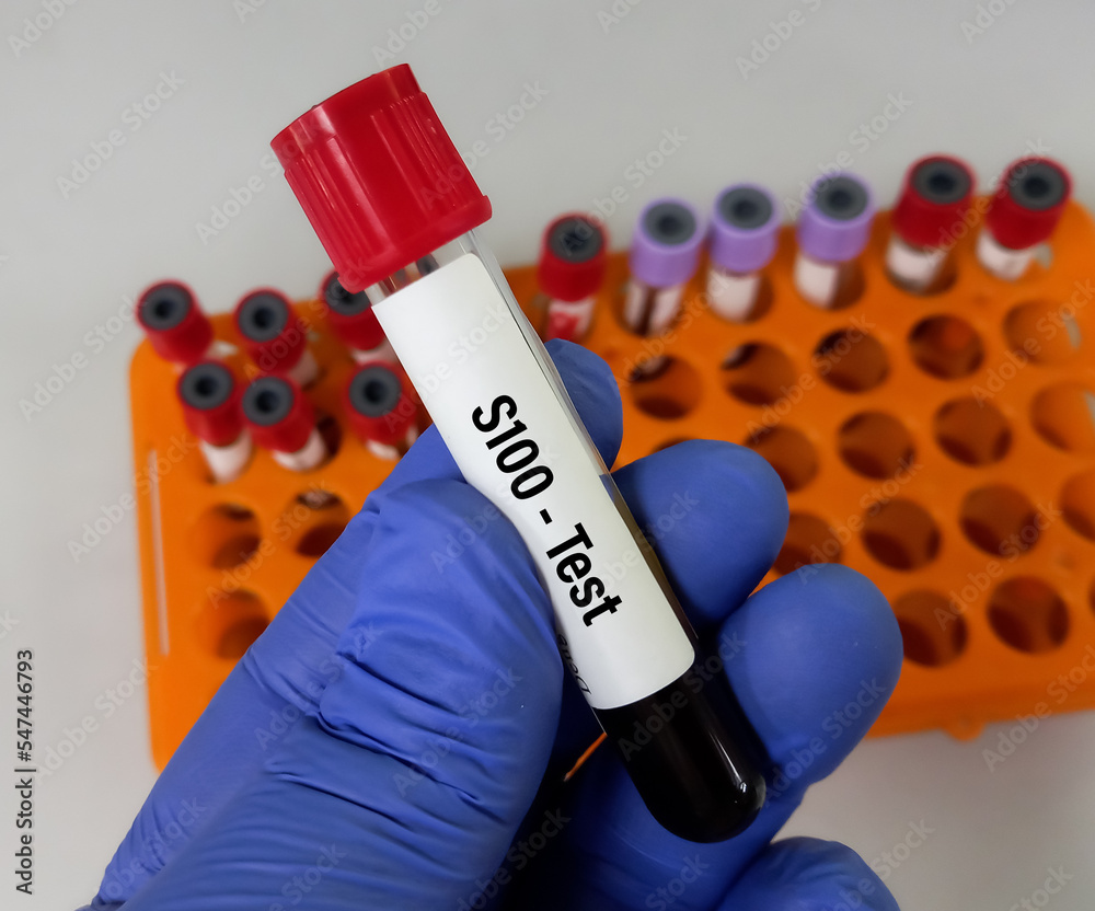 Blood sample for S100 protein test, for disease monitoring in
