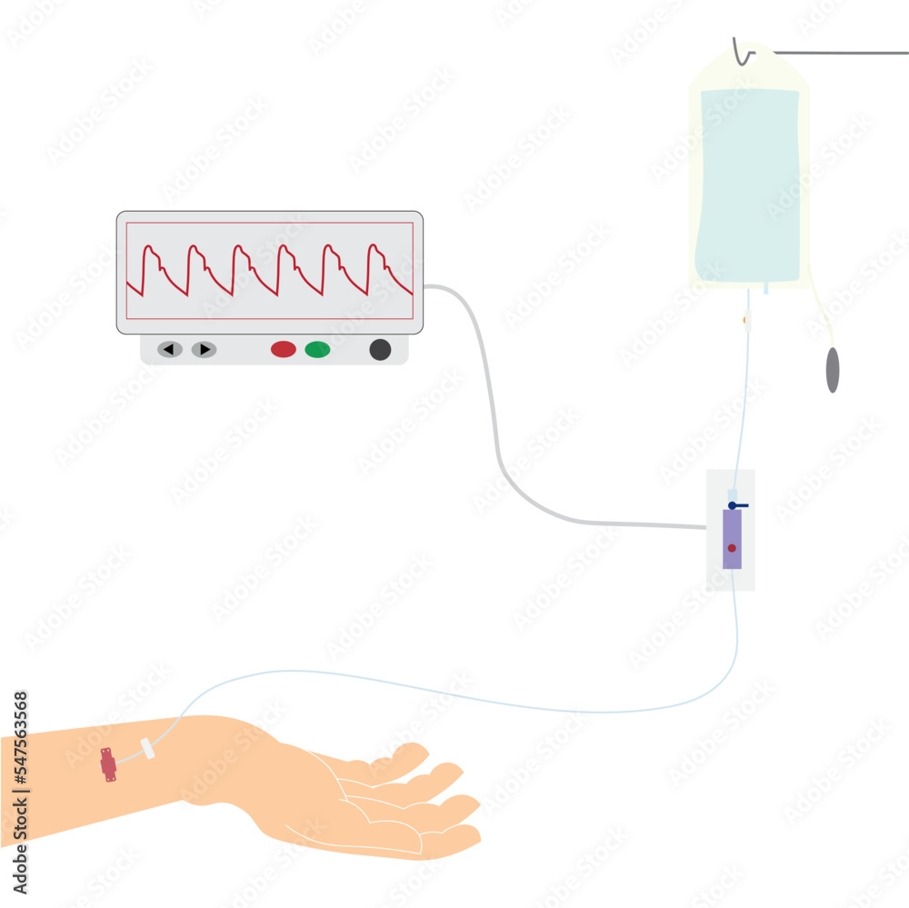 Stockvector Invasive Arterial Blood Monitoring System Hand With An 