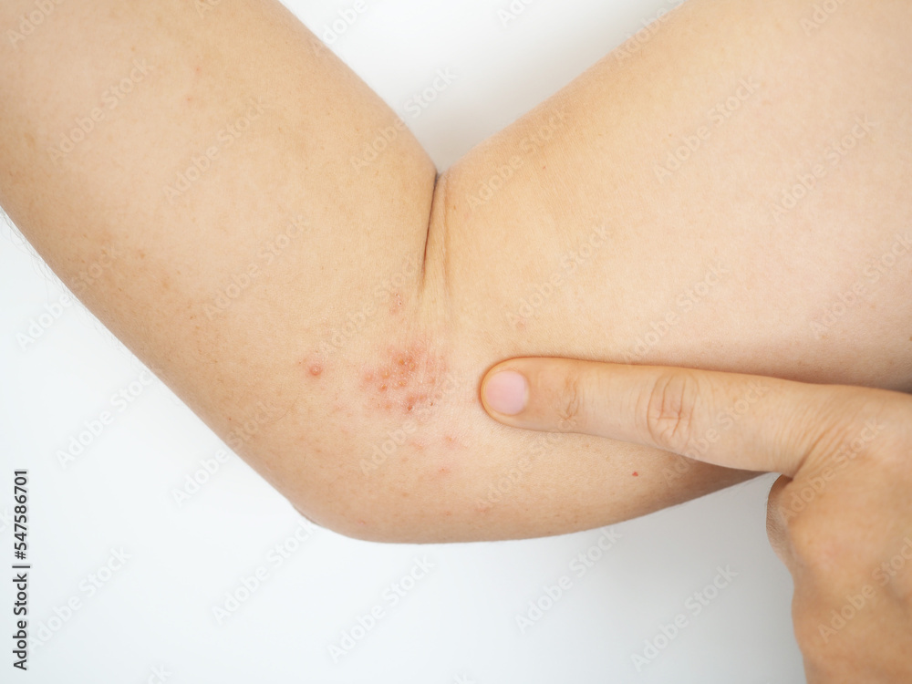 neurontin herpes zoster