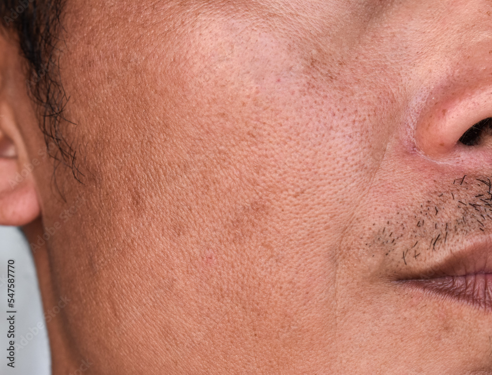 Fair skin with wide pores in the face of Asian, Myanmar or Korean adult man. Fair skin with wide pores in the face of Asian, Myanmar or Korean adult man.