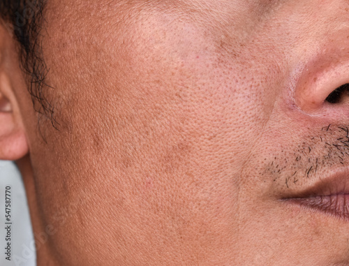Fair skin with wide pores in the face of Asian, Myanmar or Korean adult man. photo