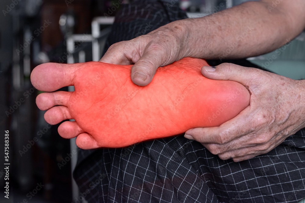 Tingling and burning sensation in foot of Asian man. Foot pain. Sensory