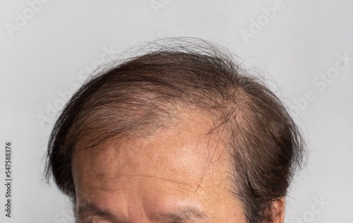 Fotografía Bald head of Asian man