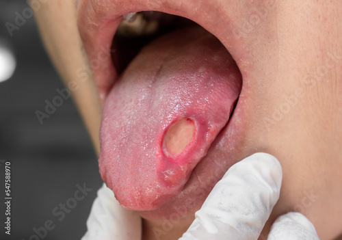 Ulcer at the tongue of Asian patient. Diagnosis may be aphthous ulcer, canker sore, stress ulcer or tongue cancer. photo