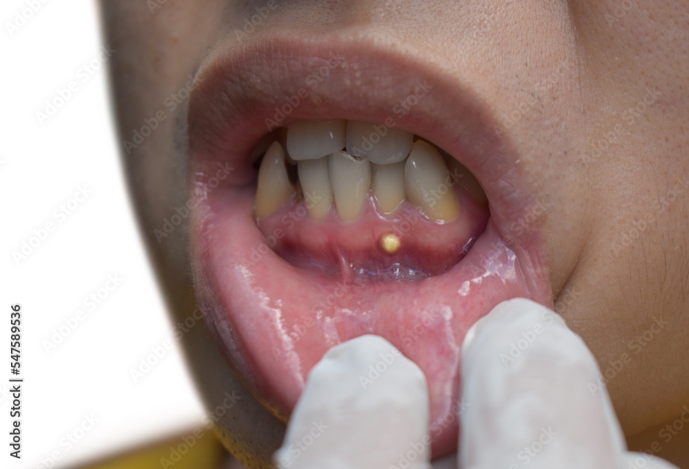 Periodontal abscess. Periapical type. Small pocket of pus in the gum ...