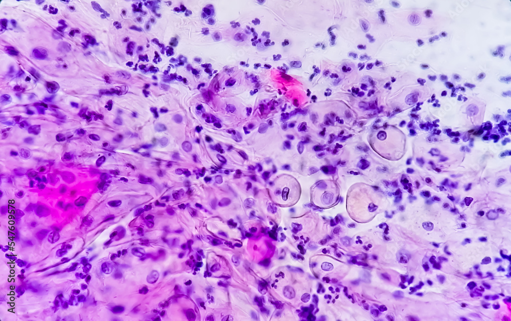Paps smear. Microscopic examination of pap smear showing inflammatory smear with early atrophic changes. NILM. cervical cancer diagnosis.