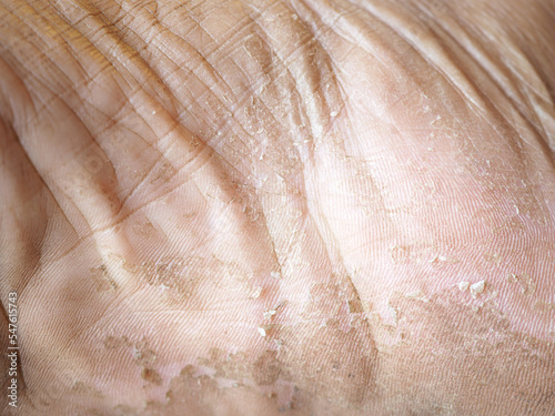 dry skin or ichthyosis texture detail in women using for moisturizer lotion, cream or beauty product concept, motion blur and macro shot photo.