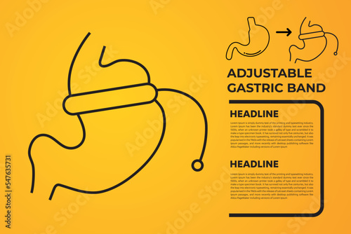 Illustration of Adjustable Gastric Band devise Weight Loss Surgery vector
