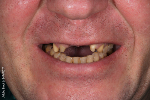 Smile with teeth prepared for ceramic crowns and veneers