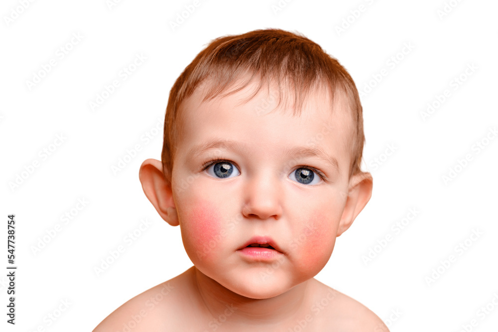 Sad toddler baby with allergies on her face, studio white background. Portrait of an unhappy allergic child with red cheeks. Kid age one year and two months Sad toddler baby with allergies on her face, studio white background. Portrait of an unhappy allergic child with red cheeks. Kid age one year and two months