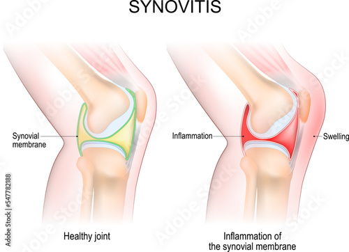 synovitis of a Knee