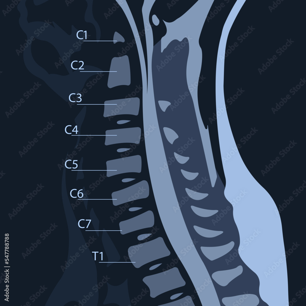 MRI of the cervical spine with and without contrast, MRI with bilateral