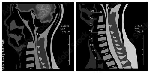 Magnetic resonance imaging of the cervical spine spine. Spondylosis and spinal cord compression