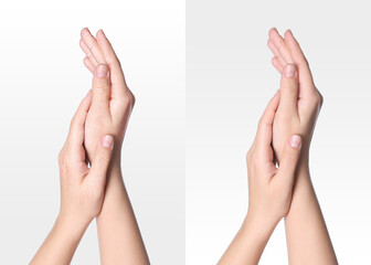 Collage with photos of woman showing hands with dry and moisturized skin on white background, closeup
