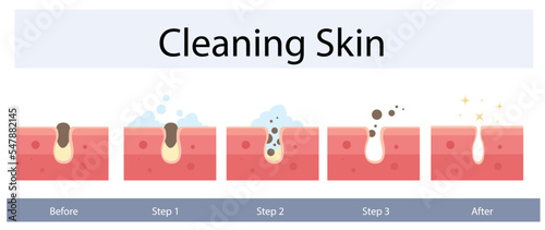 Facial skin care, pore cleaning concept. Cleansing stages on clogged face. Skin cleaning steps. Vector illustration.