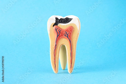 Papier peint Close-up internal tooth structure model with fisrt step of caries decay  on blue