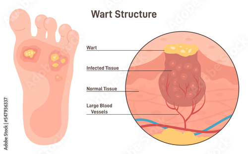 Foot warts. Type of human papillomavirus on the bottom of soles and toes