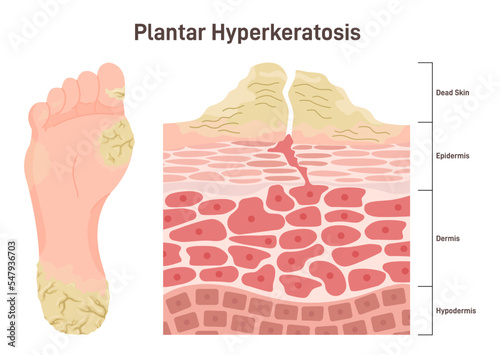 Plantar hyperkeratosis. Feet corns and calluses, medical condition photo