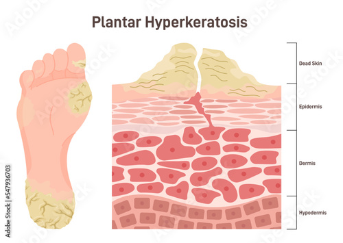 Plantar hyperkeratosis. Feet corns and calluses, medical condition