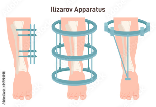 The Ilizarov apparatus set. External ring fixation technique in orthopedic