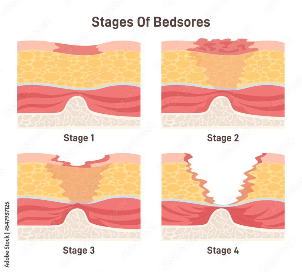 Bedsore stages set. Pressure sores areas on human body parts. Pressure Stock Vector Adobe Stock