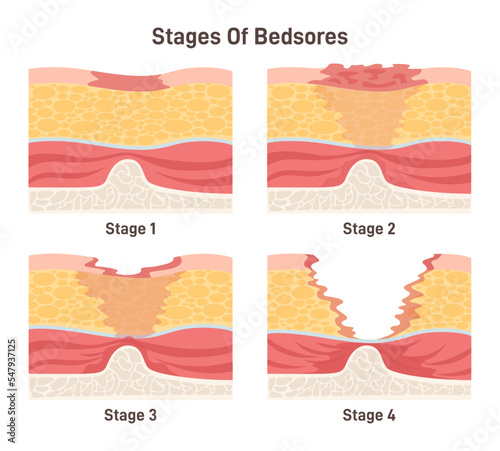 Bedsore stages set. Pressure sores areas on human body parts. Pressure