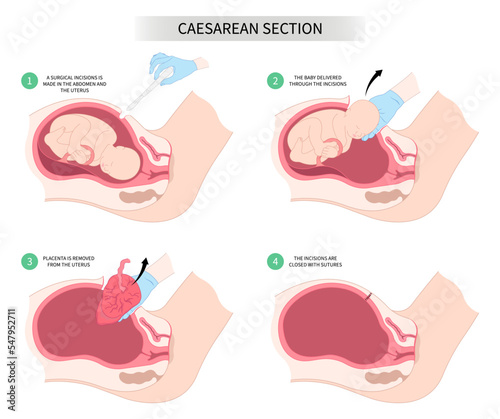 Newborn Baby birth prolapse umbilical cord twins Pregnancy scar womb tummy women Spinal Anaesthesia block uterus infant Fetal fetus mother belly Labour feet high blood pressure preeclampsia pain
