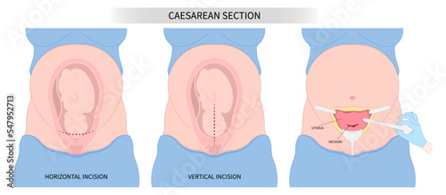 prolapse umbilical cord Women tummy belly scar of Pregnancy Newborn Baby birth twins womb Spinal Anaesthesia block uterus infant Fetal fetus mother Labour feet high blood pressure preeclampsia pain photo