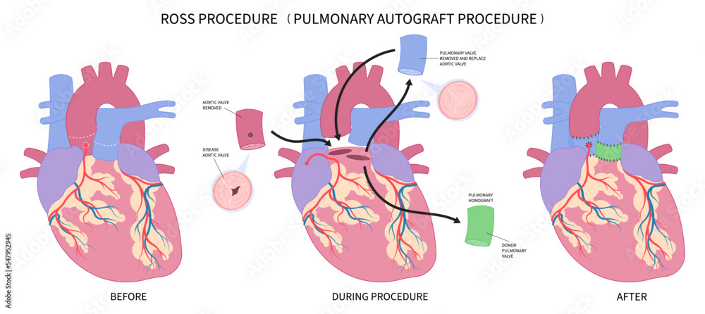 Coronary artery disease operation with procedure to dilation switch Hemorrhage baby allograft in ICU intensive care unit infection