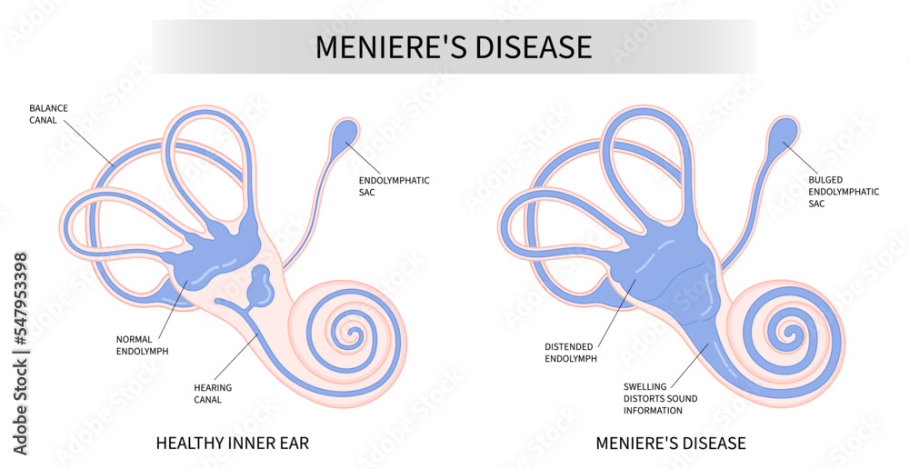 The Meniere's disease of sound in stuffy ear hear ringing roaring